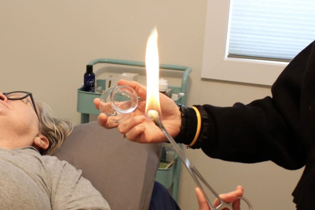 Acupuncture